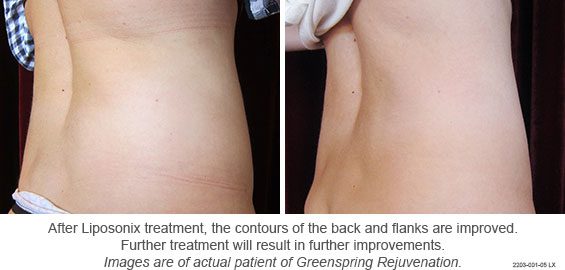 liposonix 13 green spring aesthetics - fat destroying treatment